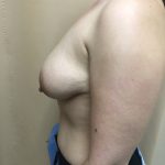 Breast Augmentation Before & After Patient #6496