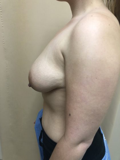 Breast Augmentation Before & After Patient #6496