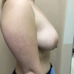 Breast Augmentation Before & After Patient #6496