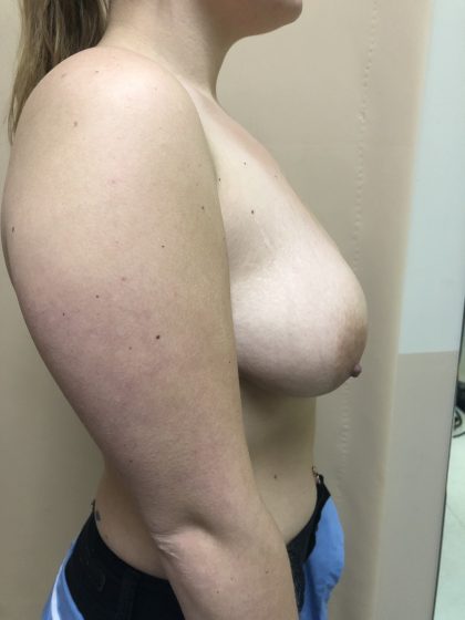 Breast Augmentation Before & After Patient #6496