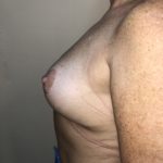 Breast Reduction Before & After Patient #6549