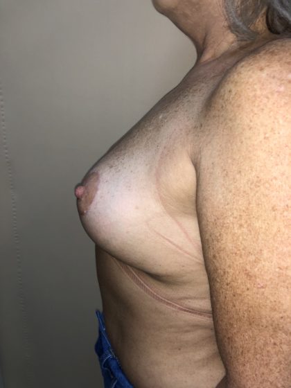 Breast Reduction Before & After Patient #6549