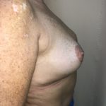 Breast Reduction Before & After Patient #6549