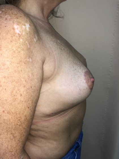 Breast Reduction Before & After Patient #6549