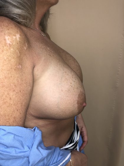 Breast Reduction Before & After Patient #6549