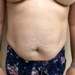 Tummy Tuck Before & After Patient #6546