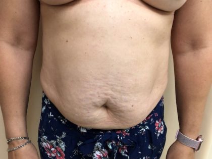 Breast Augmentation Before & After Patient #6537