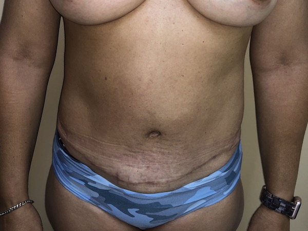 Tummy Tuck Before & After Patient #6546