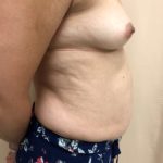 Tummy Tuck Before & After Patient #6546