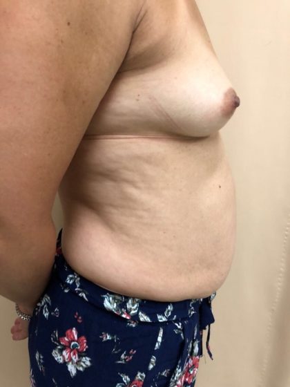 Breast Augmentation Before & After Patient #6537