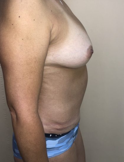 Breast Augmentation Before & After Patient #6537