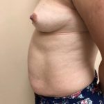 Tummy Tuck Before & After Patient #6546