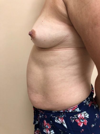 Breast Augmentation Before & After Patient #6537