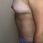 Tummy Tuck Before & After Patient #6546