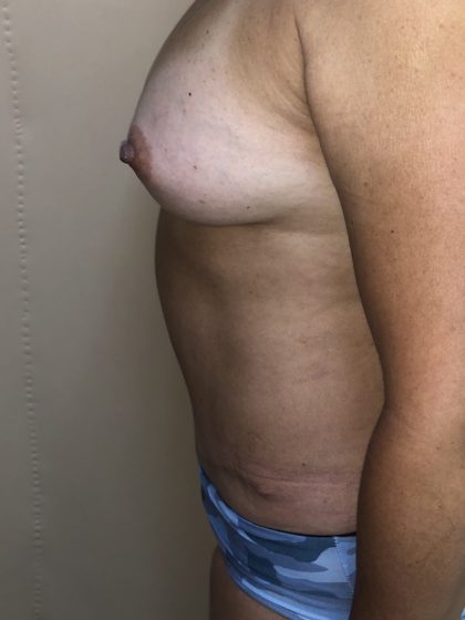 Breast Augmentation Before & After Patient #6537
