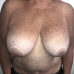 Implant Exchange Before & After Patient #6568