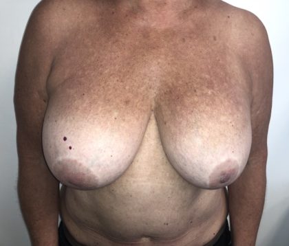 Implant Exchange Before & After Patient #6568