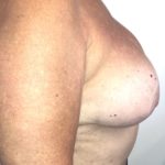 Implant Exchange Before & After Patient #6568