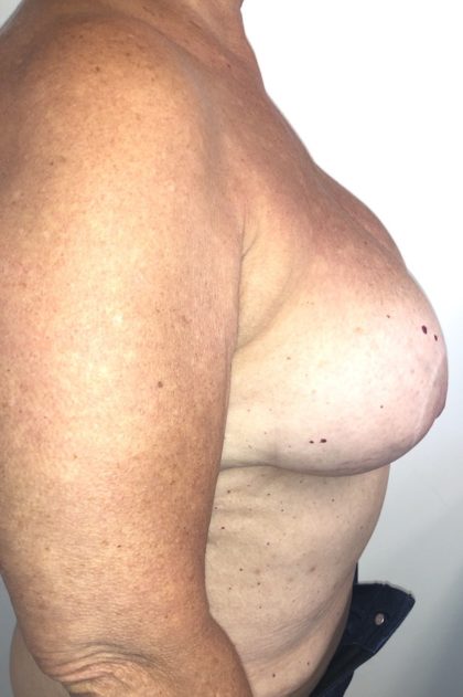 Implant Exchange Before & After Patient #6568