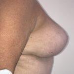 Implant Exchange Before & After Patient #6568