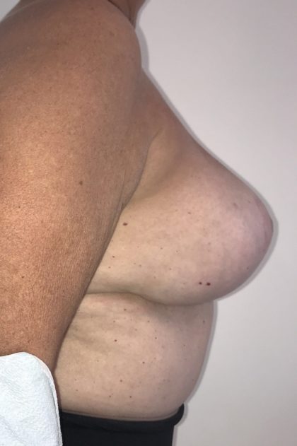 Implant Exchange Before & After Patient #6568
