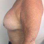 Implant Exchange Before & After Patient #6568