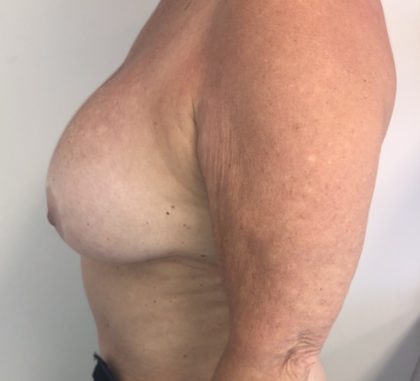 Implant Exchange Before & After Patient #6568