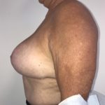 Implant Exchange Before & After Patient #6568
