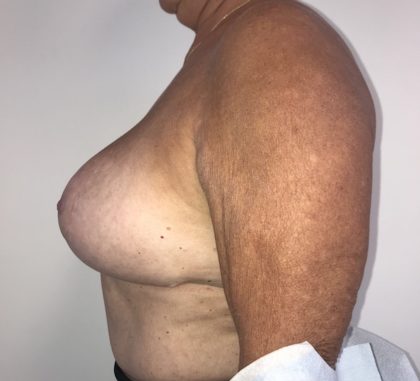 Implant Exchange Before & After Patient #6568