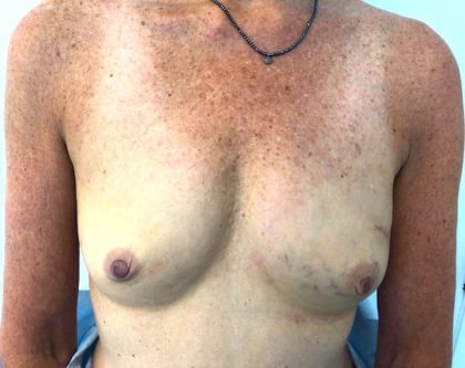 Breast Reconstruction Before & After Patient #6561