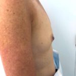 Breast Reconstruction Before & After Patient #6561
