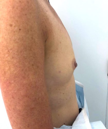 Breast Reconstruction Before & After Patient #6561