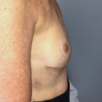 Breast Reconstruction Before & After Patient #6561