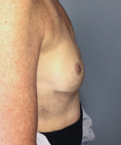 Breast Reconstruction Before & After Patient #6561