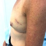 Breast Reconstruction Before & After Patient #6561