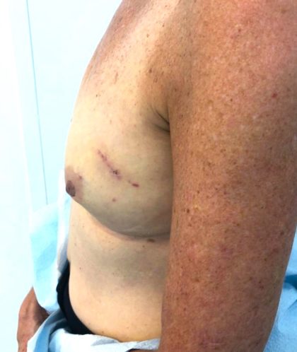 Breast Reconstruction Before & After Patient #6561