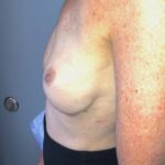 Breast Reconstruction Before & After Patient #6561