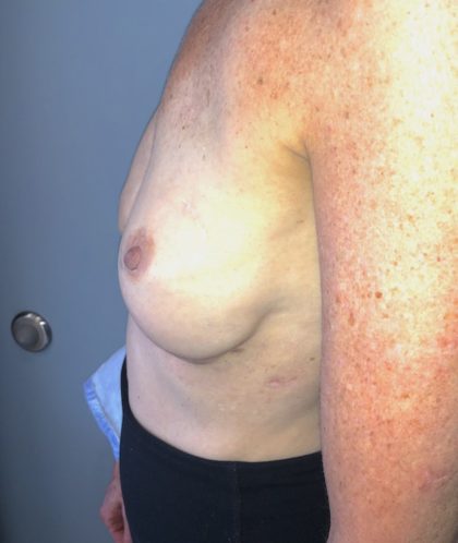 Breast Reconstruction Before & After Patient #6561
