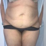 Tummy Tuck Before & After Patient #6634