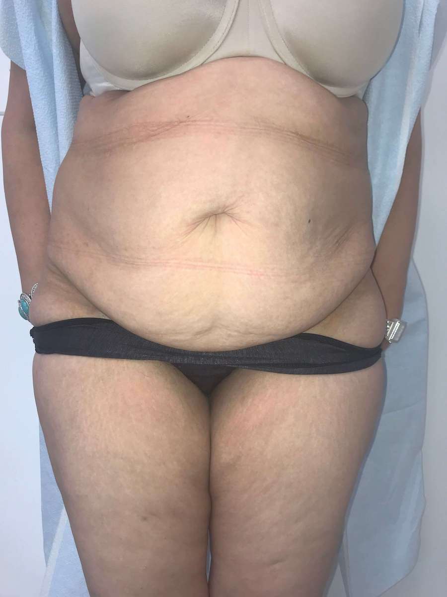 Tummy Tuck Before & After Patient #6634