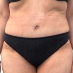 Tummy Tuck Before & After Patient #6634