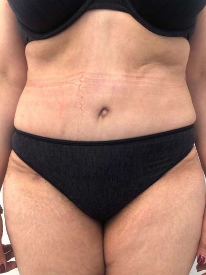 Tummy Tuck Before & After Patient #6634