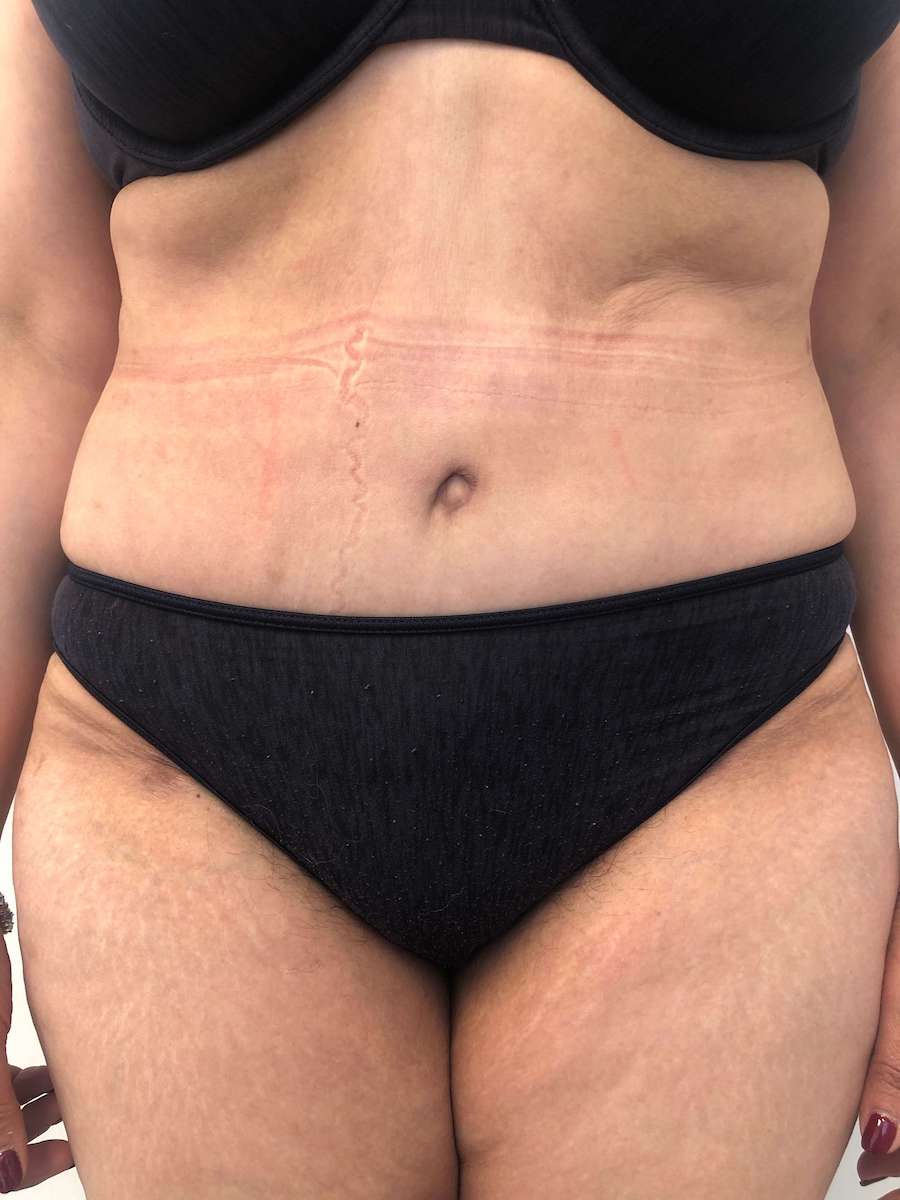 Tummy Tuck Before & After Patient #6634