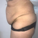 Tummy Tuck Before & After Patient #6634
