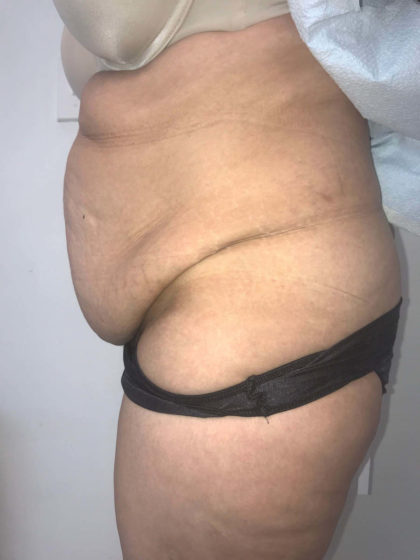 Tummy Tuck Before & After Patient #6634