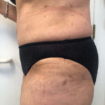 Tummy Tuck Before & After Patient #6634