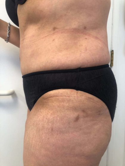 Tummy Tuck Before & After Patient #6634