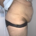 Tummy Tuck Before & After Patient #6634