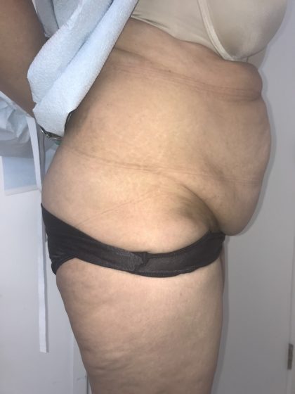 Tummy Tuck Before & After Patient #6634