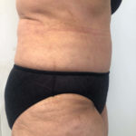 Tummy Tuck Before & After Patient #6634
